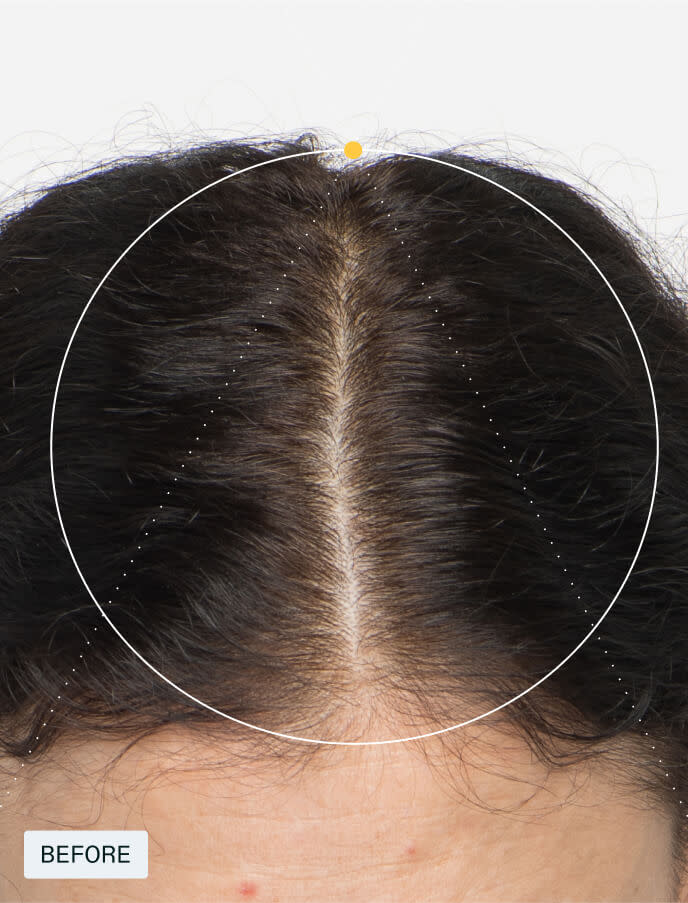 Women (Designed for women 18-44 experiencing hair thinning.)